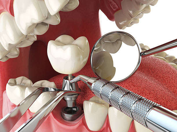 Best Emergency Treatment for Dental Infections or Abscesses in Tatamy, PA